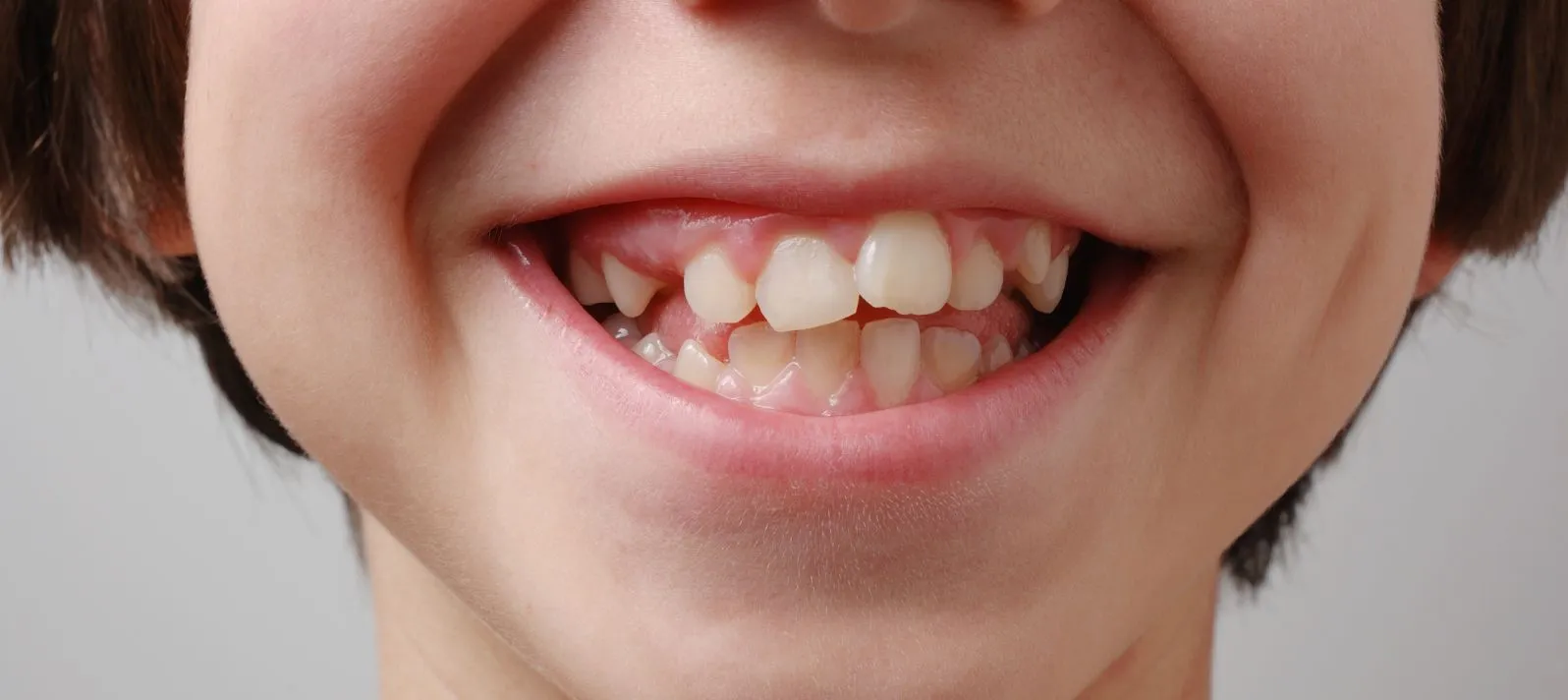 Niño sonriendo mostrando dientes con apiñamiento dental
